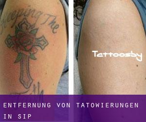 Entfernung von Tätowierungen in Sip