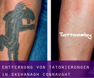 Entfernung von Tätowierungen in Skehanagh (Connaught)