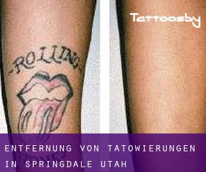 Entfernung von Tätowierungen in Springdale (Utah)