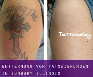 Entfernung von Tätowierungen in Sunbury (Illinois)