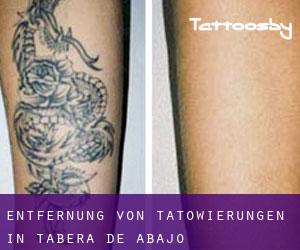 Entfernung von Tätowierungen in Tabera de Abajo