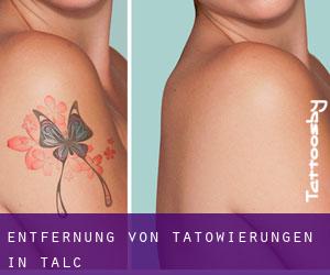 Entfernung von Tätowierungen in Talc