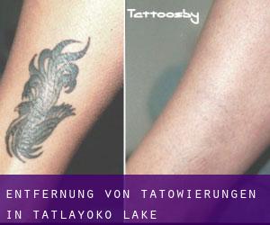 Entfernung von Tätowierungen in Tatlayoko Lake