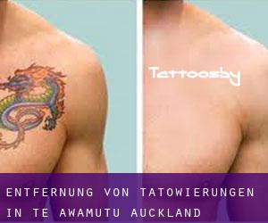 Entfernung von Tätowierungen in Te Awamutu (Auckland)