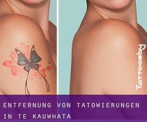 Entfernung von Tätowierungen in Te Kauwhata