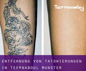 Entfernung von Tätowierungen in Teernaboul (Munster)