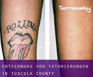 Entfernung von Tätowierungen in Tuscola County