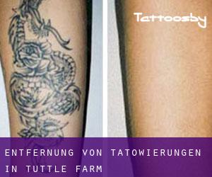 Entfernung von Tätowierungen in Tuttle Farm