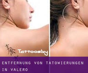 Entfernung von Tätowierungen in Valero