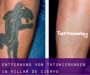 Entfernung von Tätowierungen in Villar de Ciervo