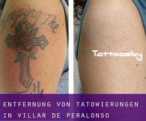 Entfernung von Tätowierungen in Villar de Peralonso