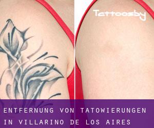 Entfernung von Tätowierungen in Villarino de los Aires