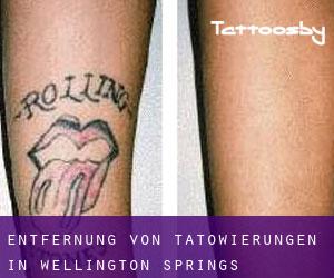Entfernung von Tätowierungen in Wellington Springs