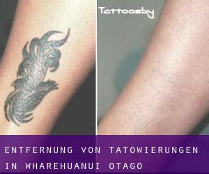 Entfernung von Tätowierungen in Wharehuanui (Otago)