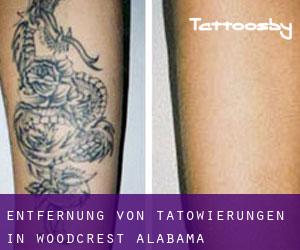 Entfernung von Tätowierungen in Woodcrest (Alabama)