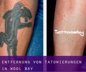 Entfernung von Tätowierungen in Wool Bay