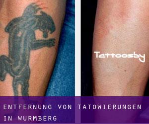 Entfernung von Tätowierungen in Wurmberg