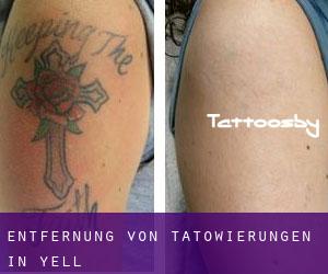 Entfernung von Tätowierungen in Yell